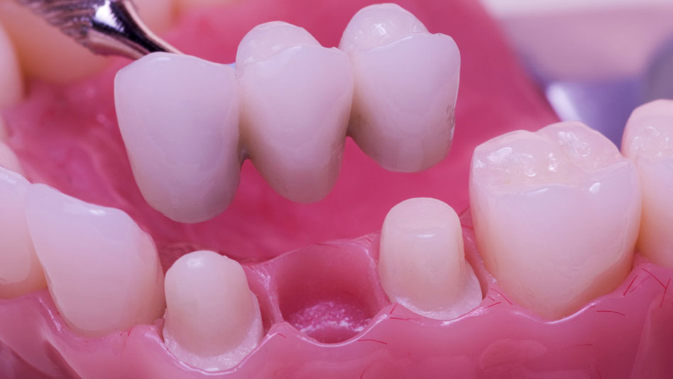 Dental Bridges @ New Millennium Dental
