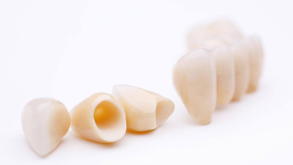 Dental Crowns @ New Millennium Dental