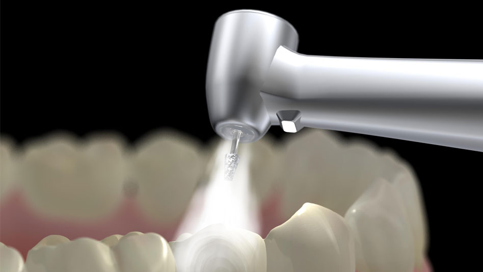Tooth Fillings @ New Millennium Dental