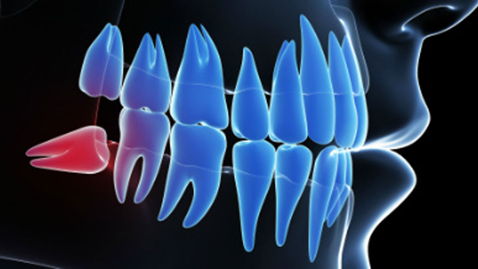 Treating Wisdom Teeth Problems @ New Millennium Dental