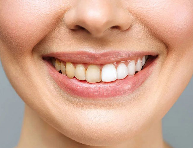 Why Have My Teeth Changed Colour Over the Years?