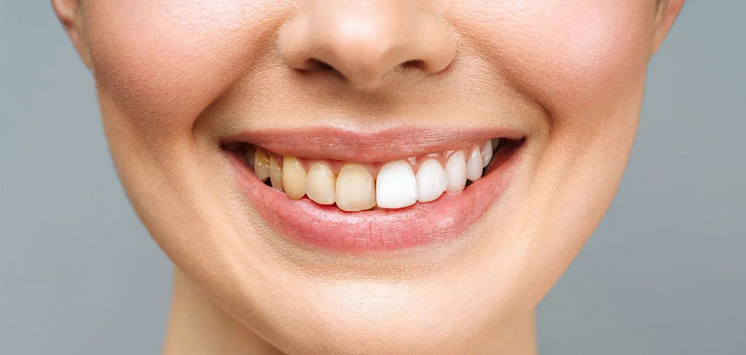 Why Are My Teeth Turning Yellow?