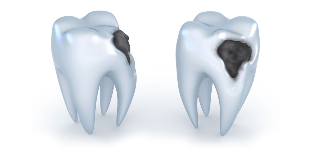 Tooth Decay