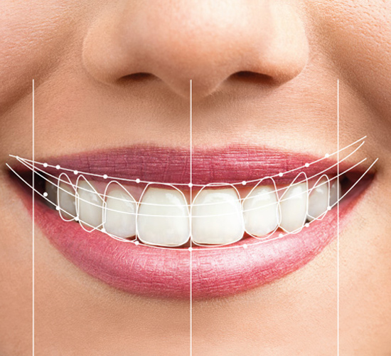 Smile Makeover