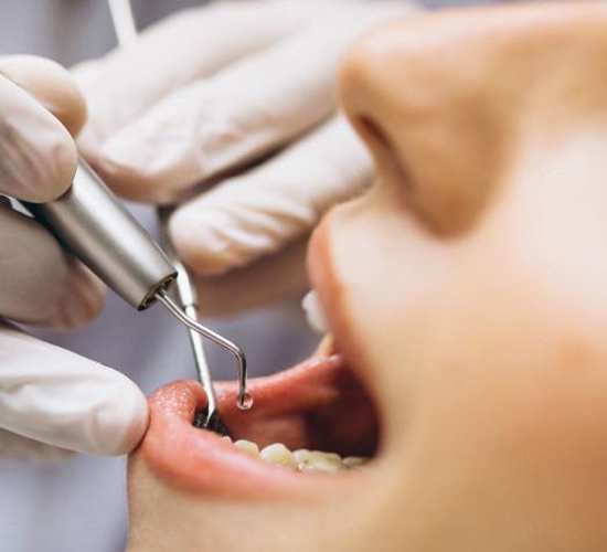 Root Canal Treatment