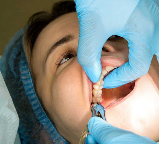 Wisdom Teeth Removal