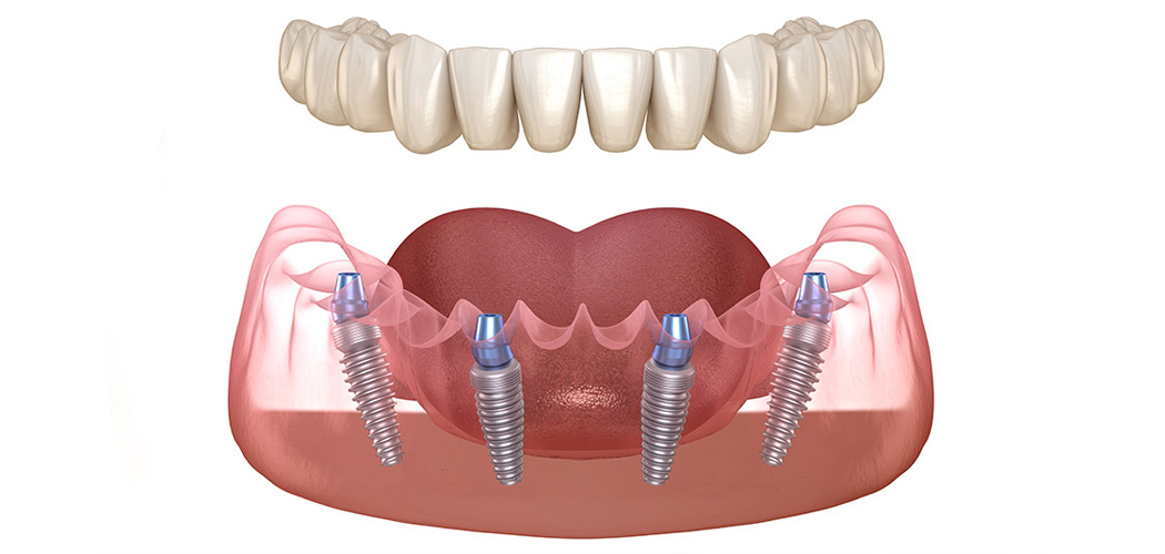 All-on-4 Dental Implants?