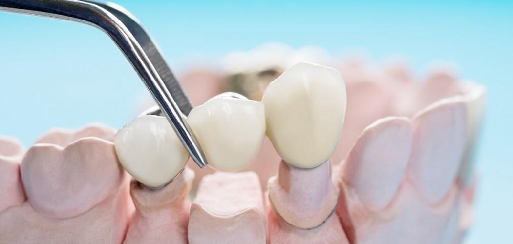 Dental Bridges in Bentleigh