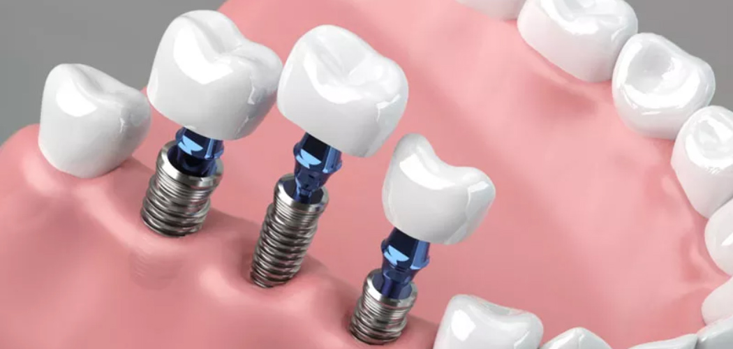 What Are Dental Implants?