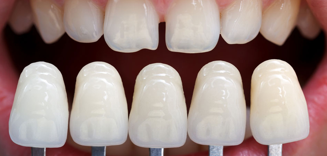 Dental Veneers in Bentleigh