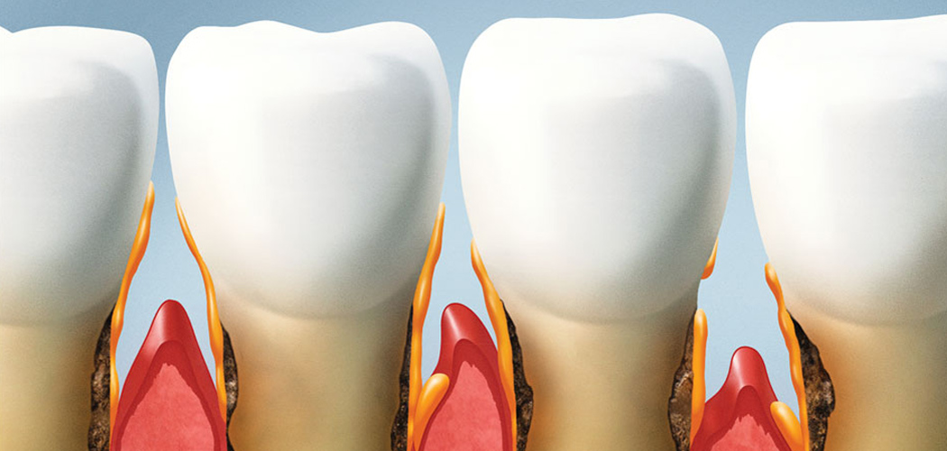 Gum Disease Treatment in Bentleigh