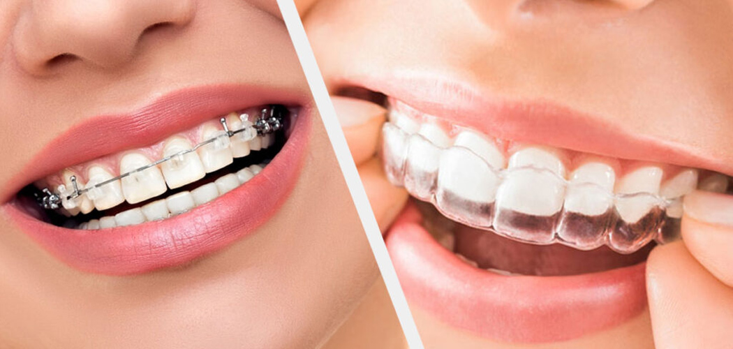 Why choose Invisalign?