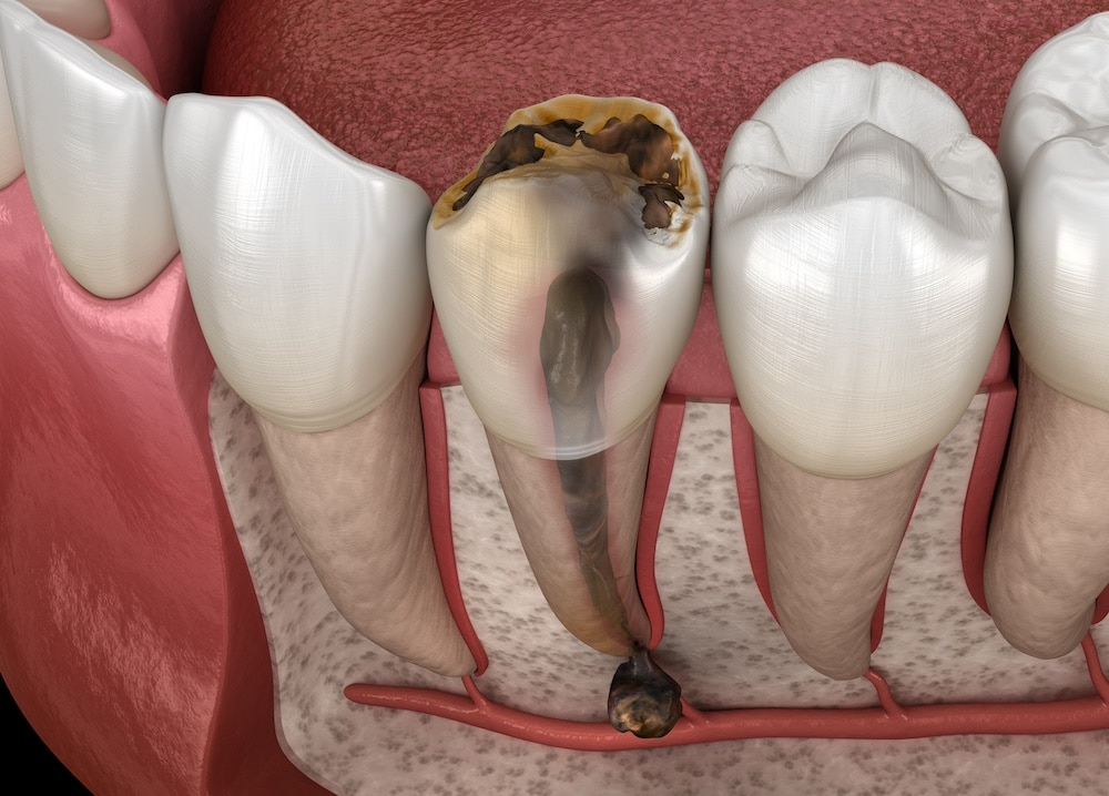 Root Canal Treatment in Bentleigh