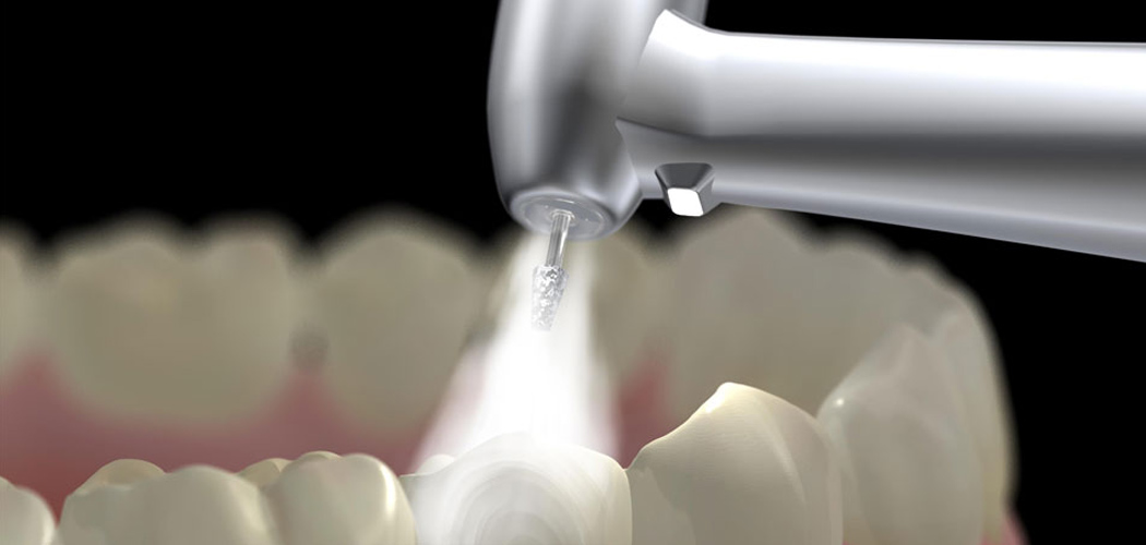 Mercury-Free Tooth Fillings in Bentleigh