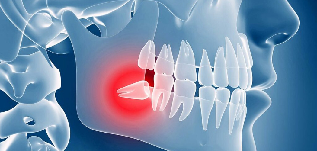 Wisdom Teeth Removal in Bentleigh