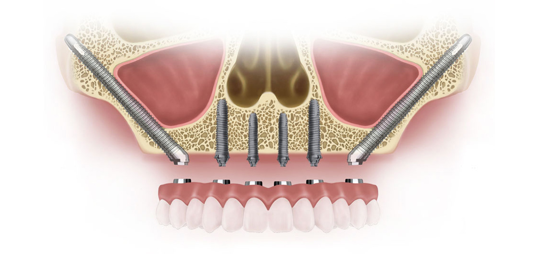 Zygomatic Dental Implants