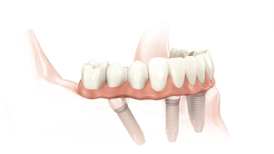 All-on-4 Dental Implants @ New Millennium Dental