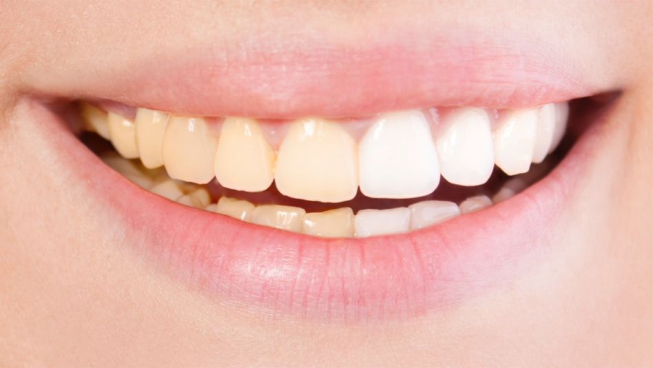 Why teeth change colour over the years?