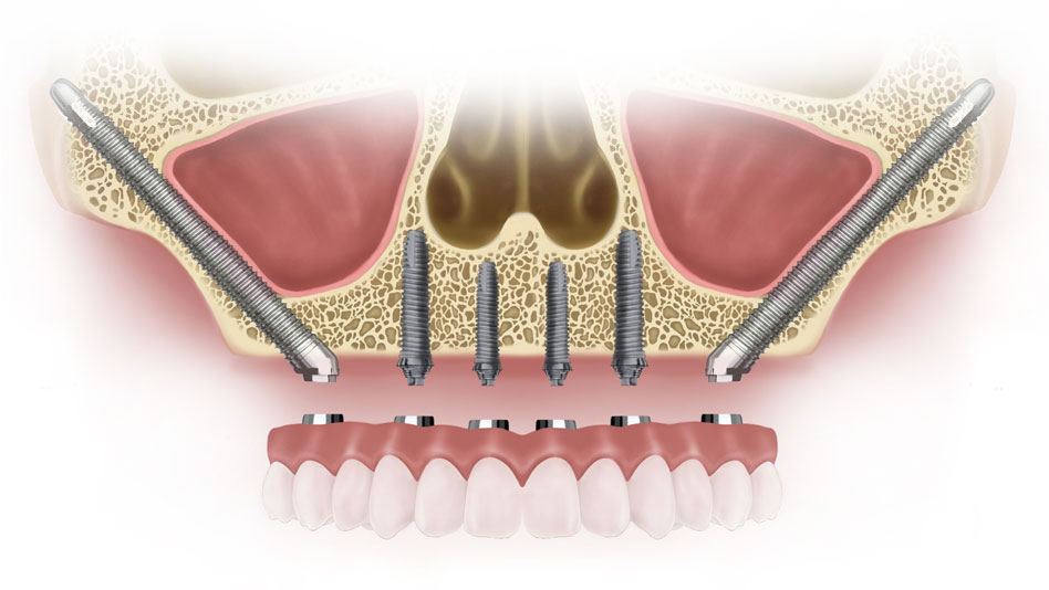 Cheekbone (Zygomatic) Dental Implants