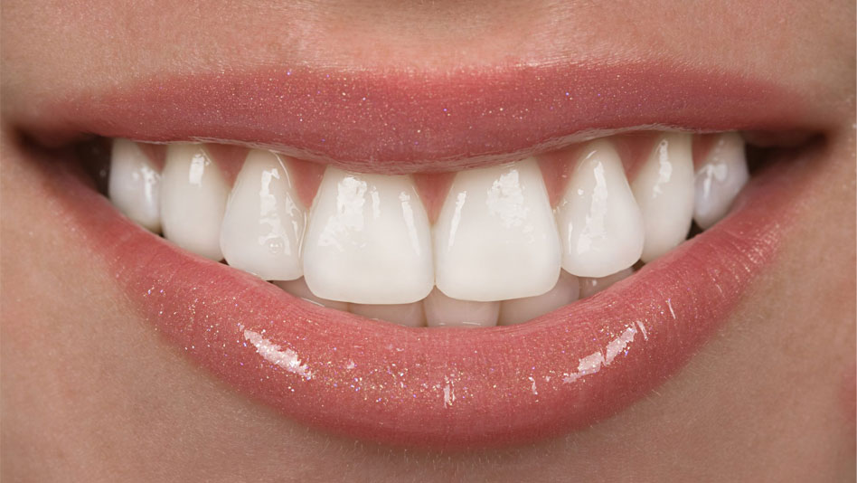 Dental Veneers Melbourne