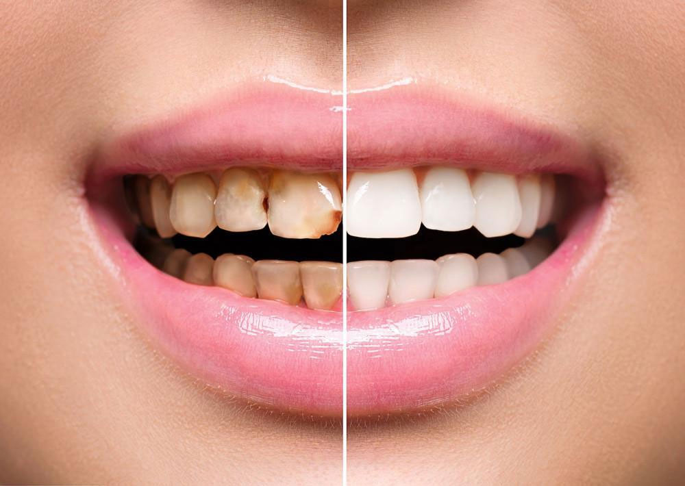 Full Mouth Reconstruction @ New Millennium Dental