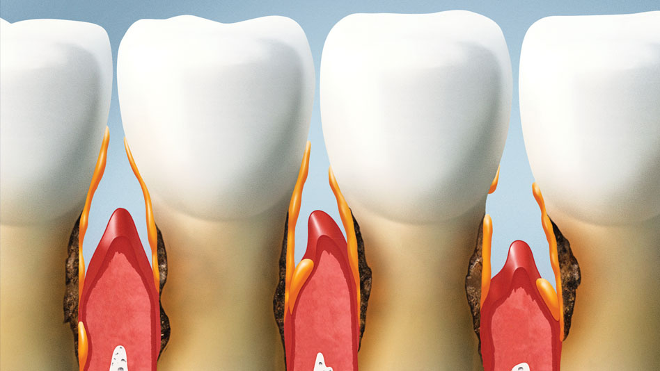 Gum Desease Treatment @ New Millennium Dental