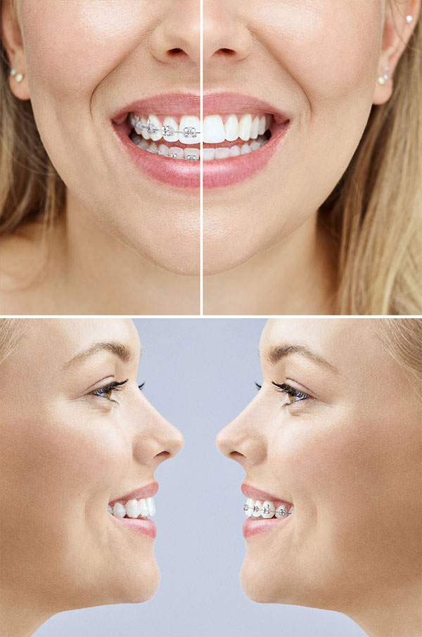 Invisalign @ New Millennium Dental