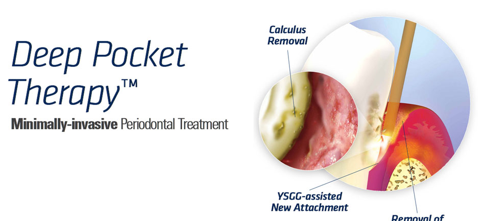 Deep Pocket Therapy™ Periodontal