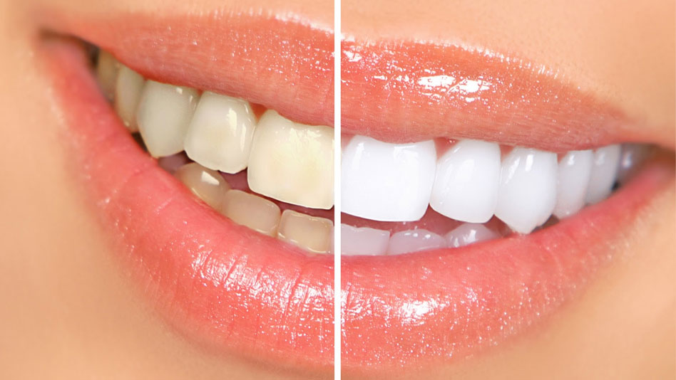 Teeth Whitening @ New Millennium Dental