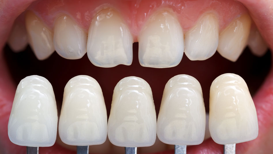 Teeth Veneers @ New Millennium Dental